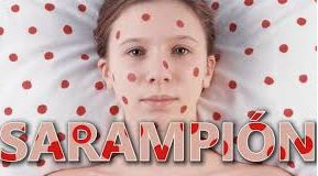 Sarampion